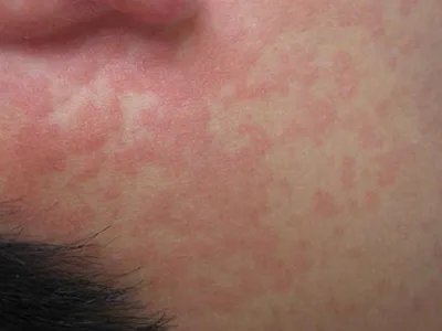 典型麻疹出疹期症状图片