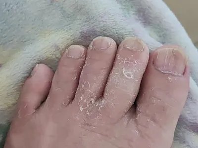 白色浅表型甲真菌病脚趾甲竖纹图片