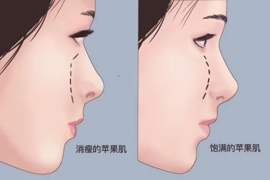 苹果肌是哪个部位