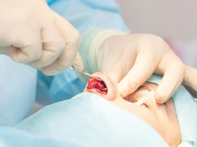 鼻子手术恢复要多久