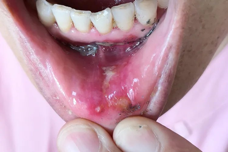 口腔黏膜受损什么症状图片