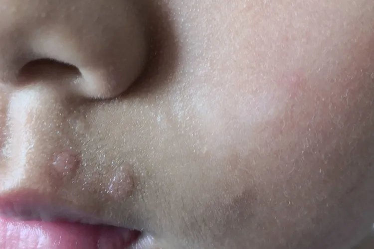 什么叫扁平疣，长什么样