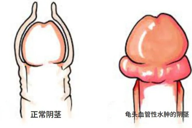 龟头感染霉菌症状图片