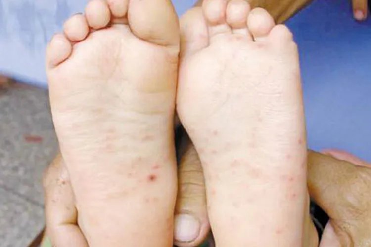 手足口病症状初期图片,痒不痒