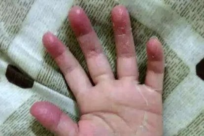 一到夏季儿童手指头脱皮图片