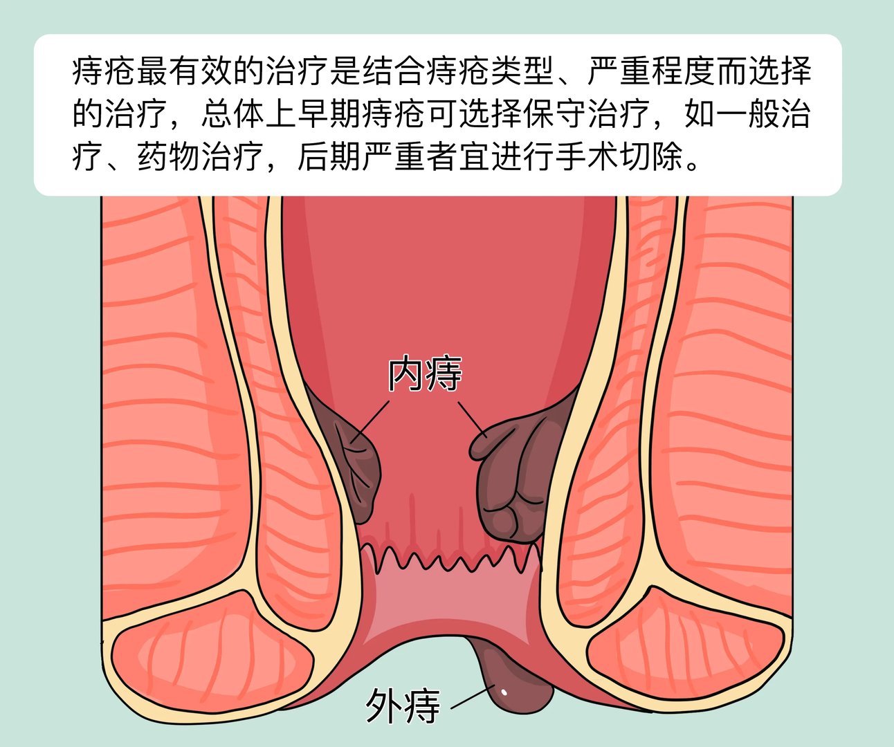 痔疮怎么治疗最有效