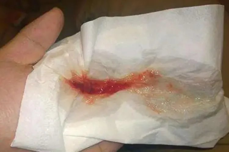 喉部鳞状细胞癌图片