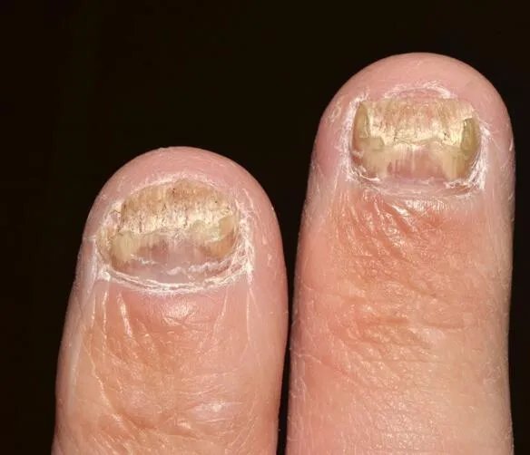 最轻微的灰指甲图 灰指甲轻微症状图片精选