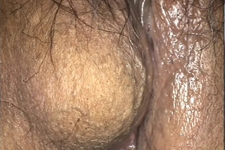 女性前庭大腺囊肿图片