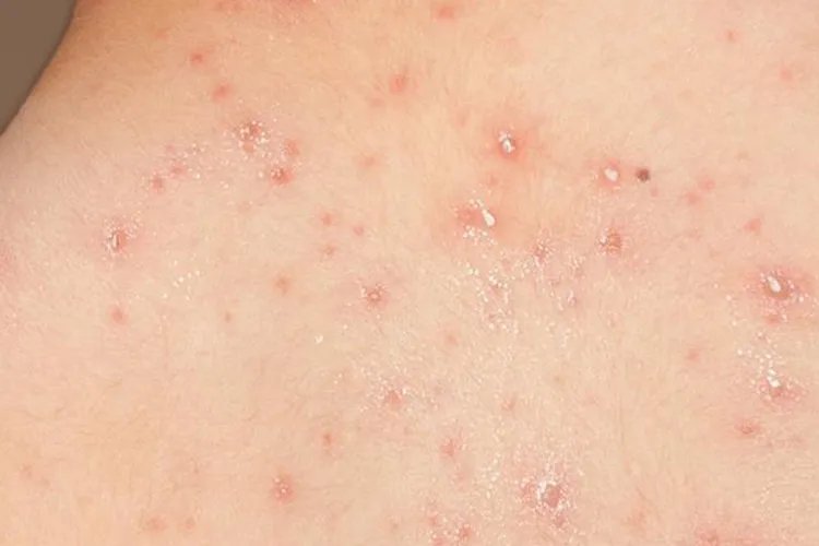 水痘初期症状图片,水痘一般年龄