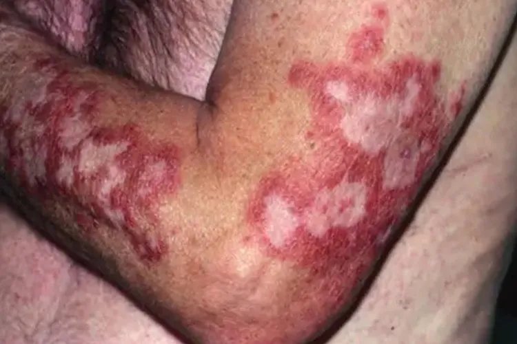 红斑狼疮对照图