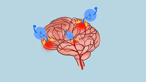 骨纤维肉瘤是什么