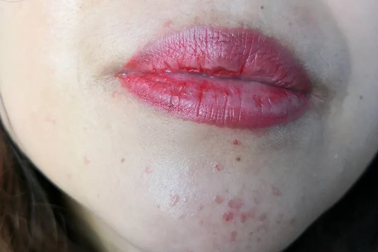 什么叫扁平疣，长什么样