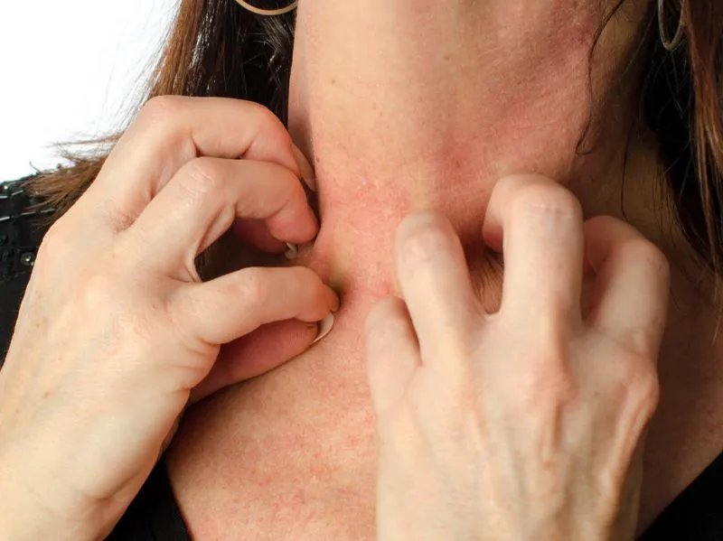 皮炎和湿疹一样吗