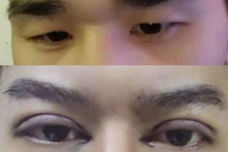 男生开眼角对比效果图