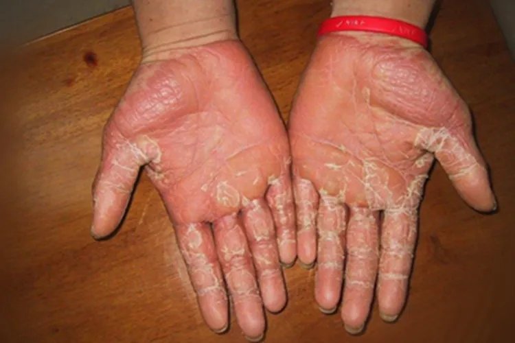寻常型鱼鳞病手掌纹图片