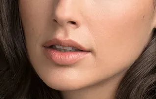 下巴注射玻尿酸后注意事项