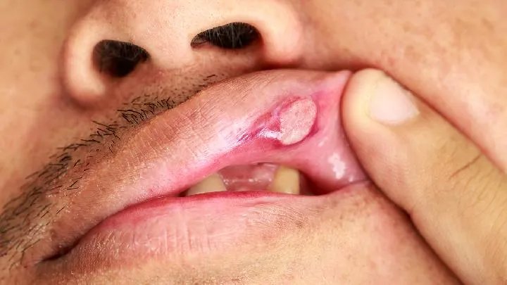 口腔溃疡吃什么好的快？口腔溃疡就吃这些食物