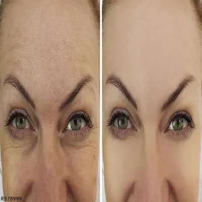 脸上的色斑的形成原因有哪些 7大坏习惯促使色斑形成