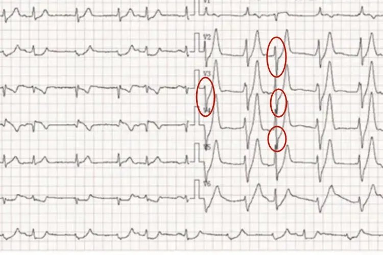 心肌梗死心电图