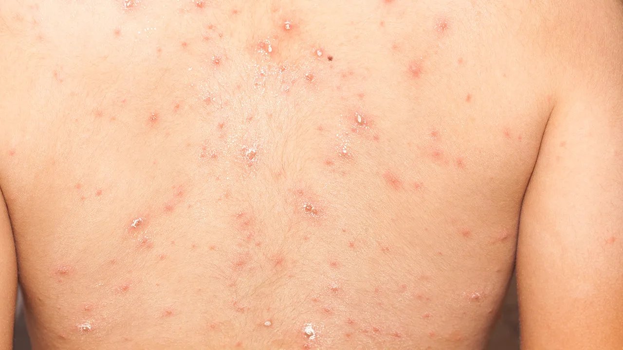 后背皮肤粗糙有小颗粒是怎么回事