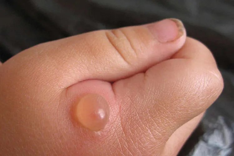 跳蚤咬了是什么样子图