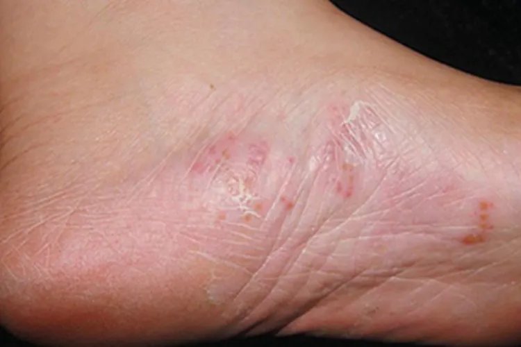 足癣脚部症状图片