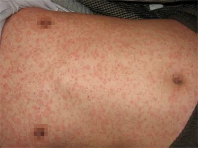 典型麻疹出疹期症状图片