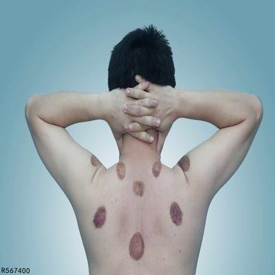 脾虚湿气重怎么办