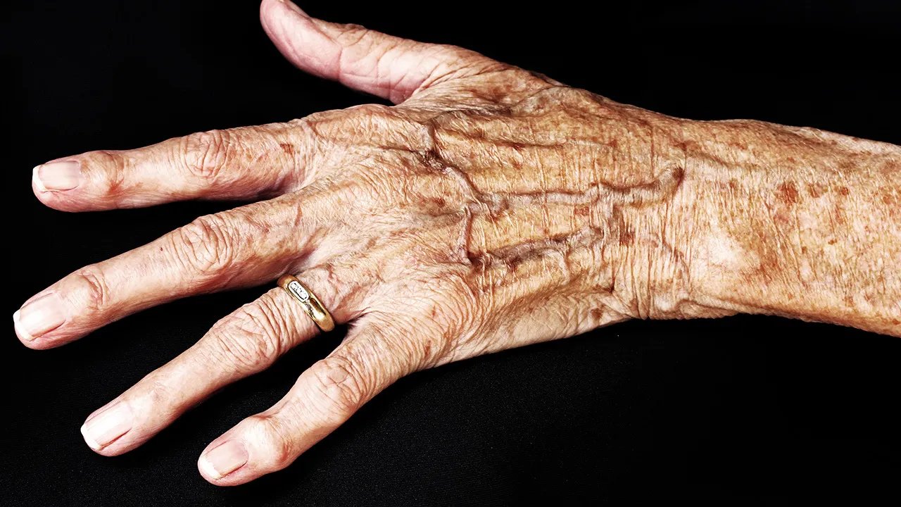 预防老年斑的方法