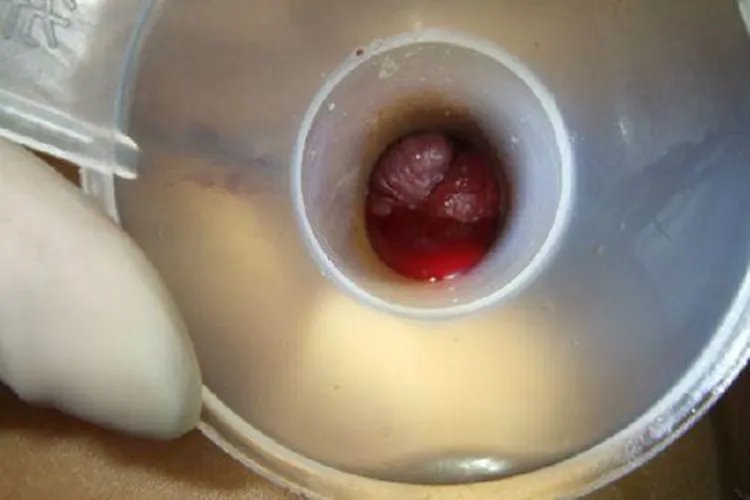 痔疮是长什么样子的