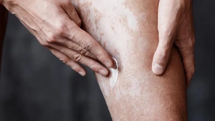 白癜风常见的症状有哪些?