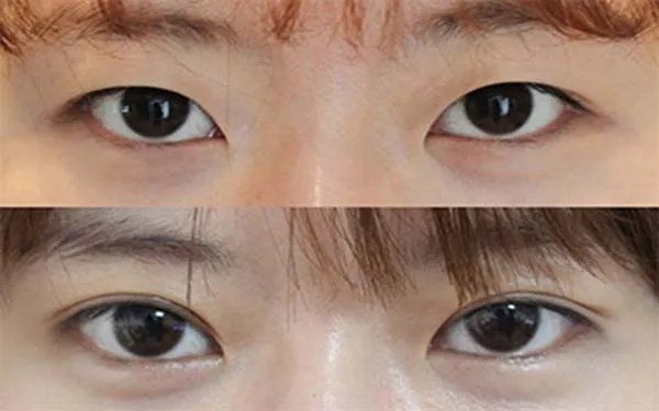 北京埋线双眼皮整形哪个医院好？