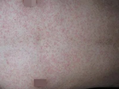 典型麻疹出疹期症状图片