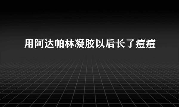 用阿达帕林凝胶以后长了痘痘