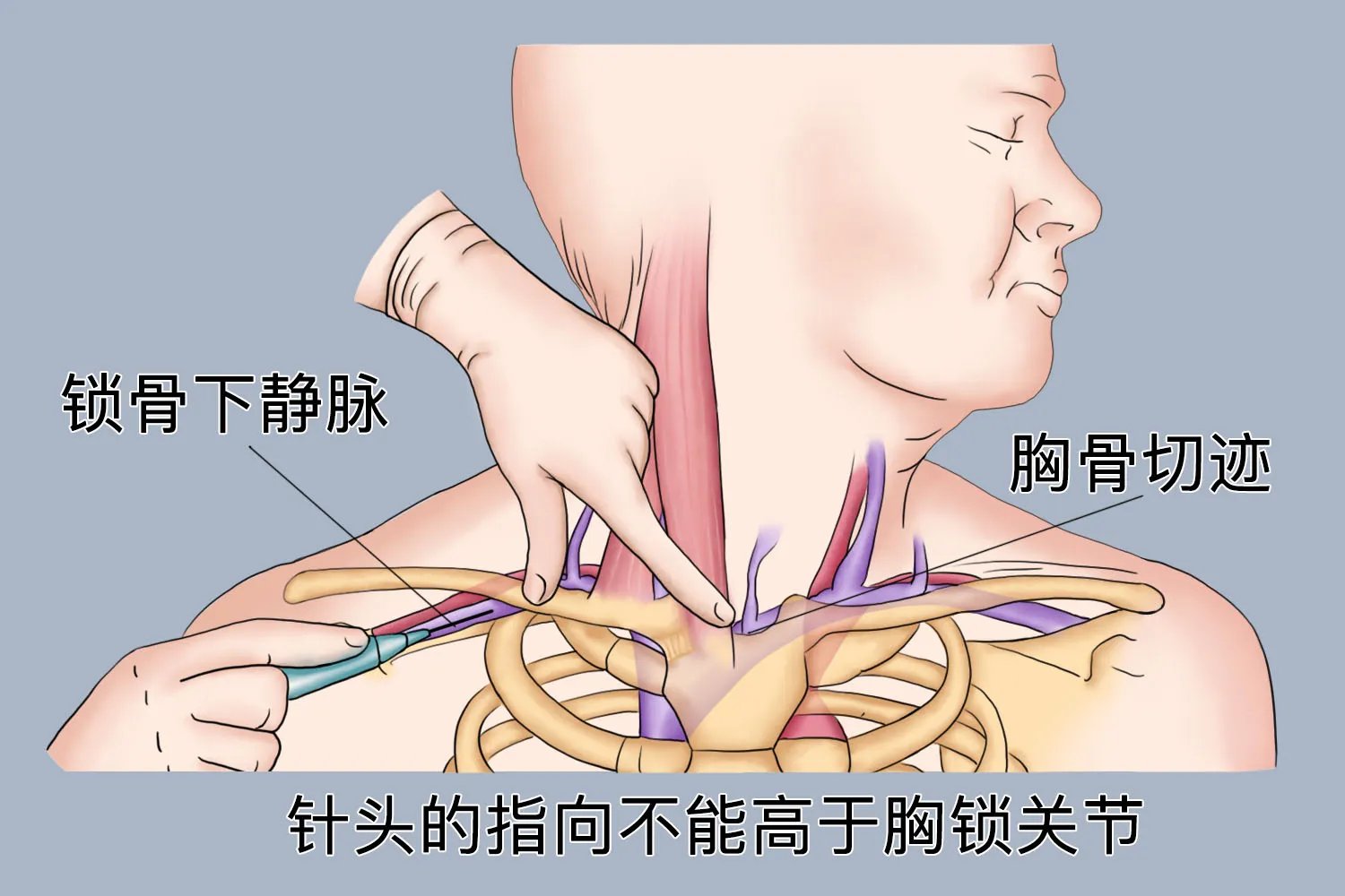 锁骨下静脉穿刺解剖图