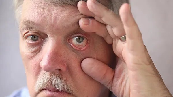 病毒性角膜炎是怎么回事 病毒性角膜炎怎么治疗