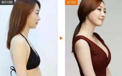 做乳房整形手术后的修复方法