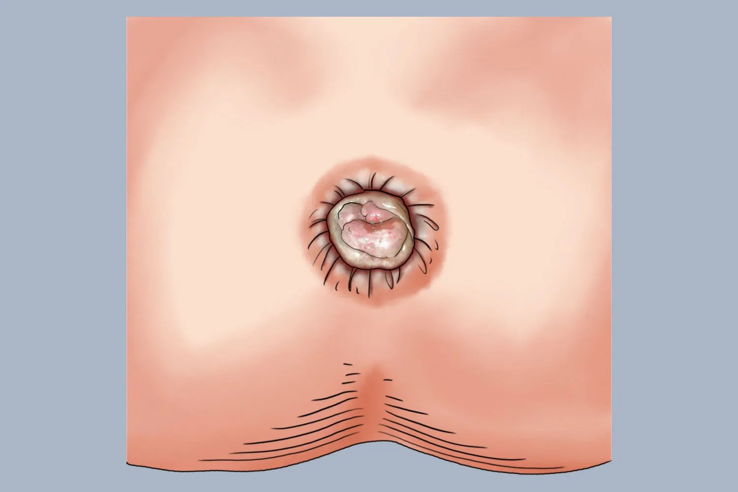 女性痔疮是什么样子的图片