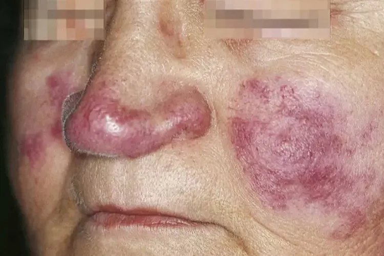 红斑狼疮对照图