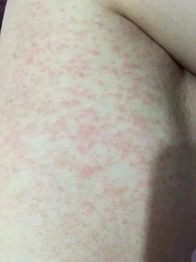 过敏性紫癫有什么症状?