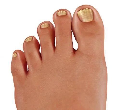 最轻微的灰指甲图 灰指甲轻微症状图片精选