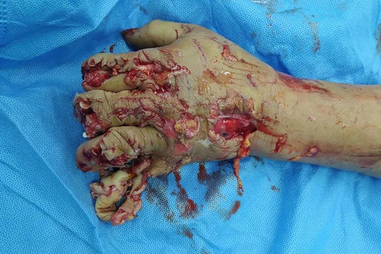 手被机器压伤严重图片