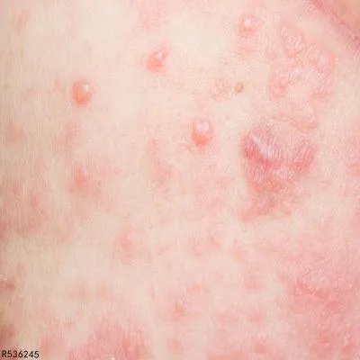 紫外线过敏用什么药改善