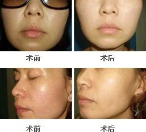 复合彩光嫩肤的价格