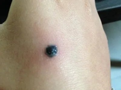 皮内痣手背黑痣图片