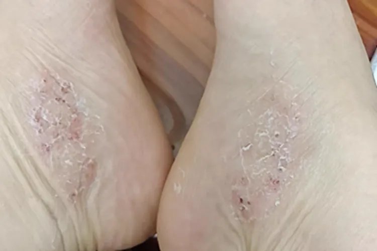 足癣脚部症状图片