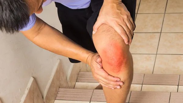 痛风的症状及治疗