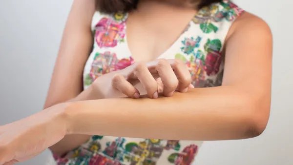 神经性皮炎的症状有哪些