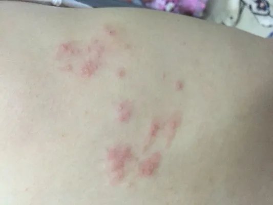 烫发药水过敏是什么症状?